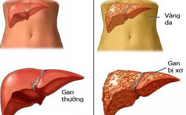 Cơ thể có 1 trong 7 dấu hiệu này chứng tỏ gan của bạn đang 'kêu cứu'